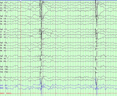 Raw data in an EEG readout